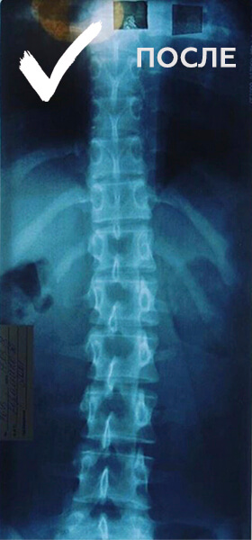 лечение сколиоза Минск